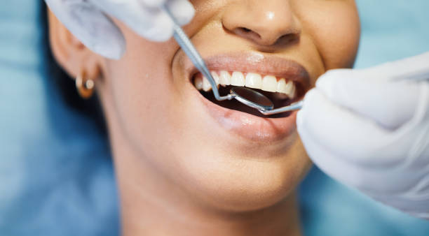 Best Emergency Wisdom Tooth Extraction in Lebanon, OR